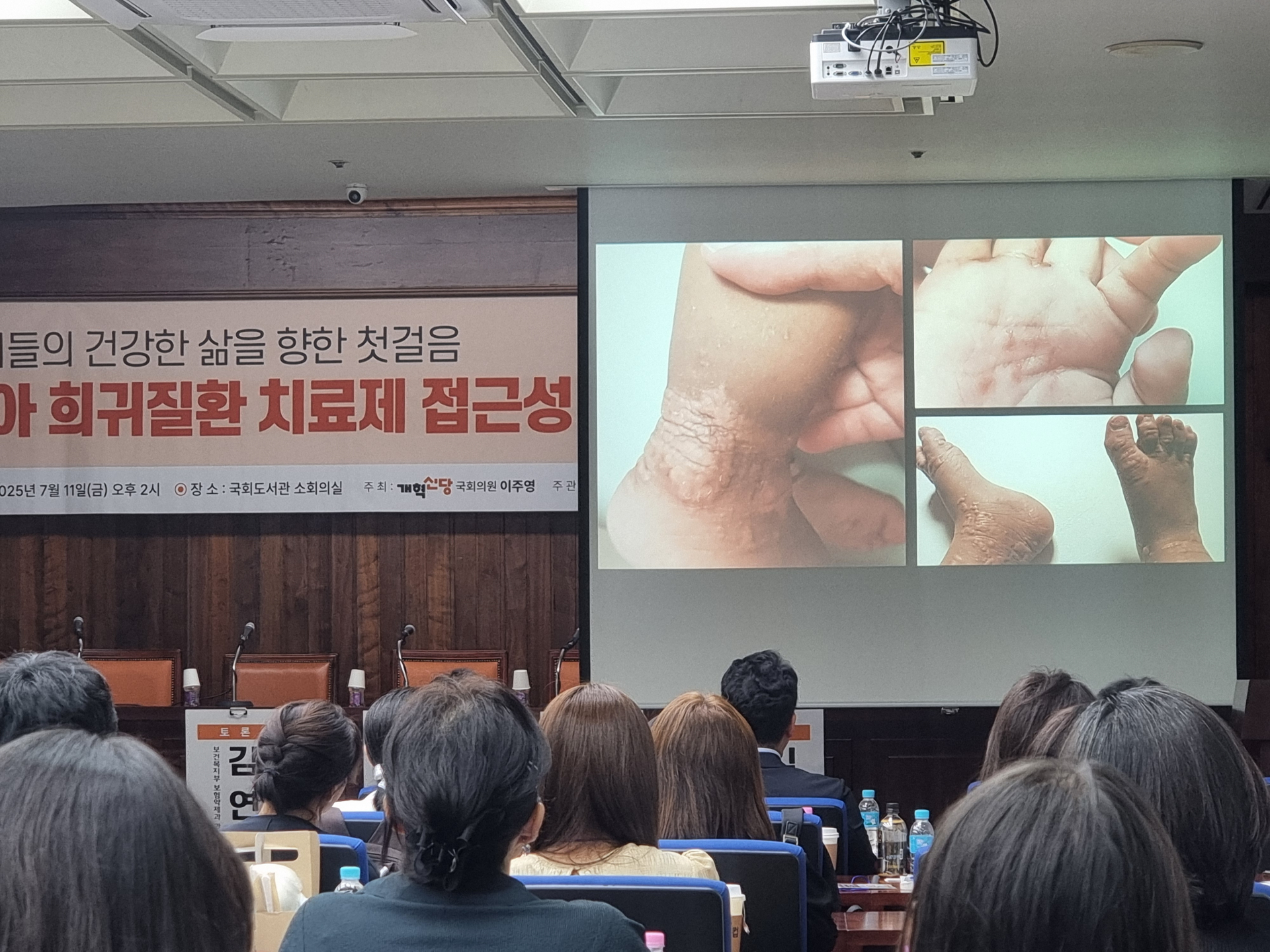 치료 사각지대 놓인 희귀질환 아이들…“치료제 접근성 강화 절실”